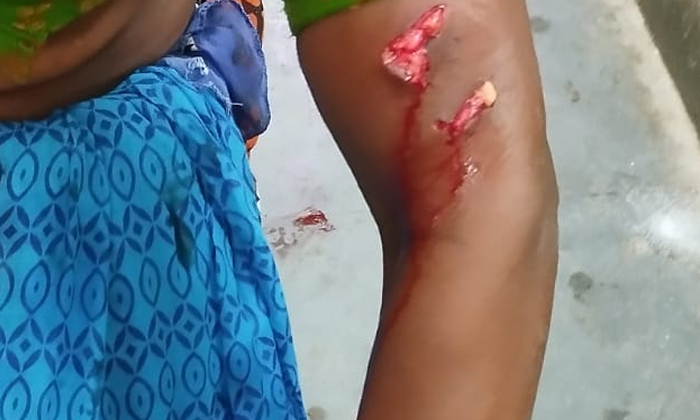  Women Are Seriously Injured By Stray Dogs , Stray Dogs , Sriramnagar, Balaji Nag-TeluguStop.com