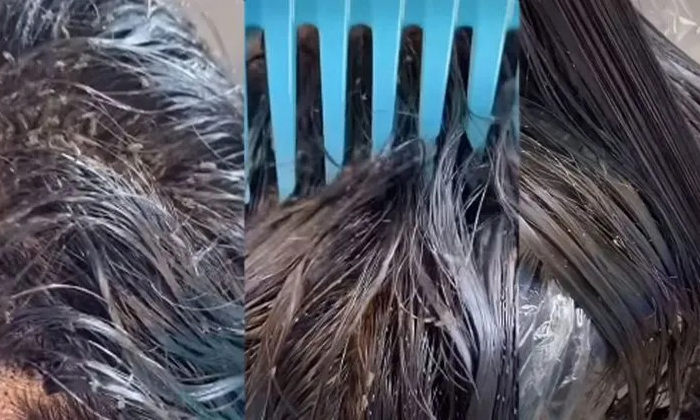  Millions Of Lice Removed From Hair With This Trick Video Viral Details, Hair, C-TeluguStop.com