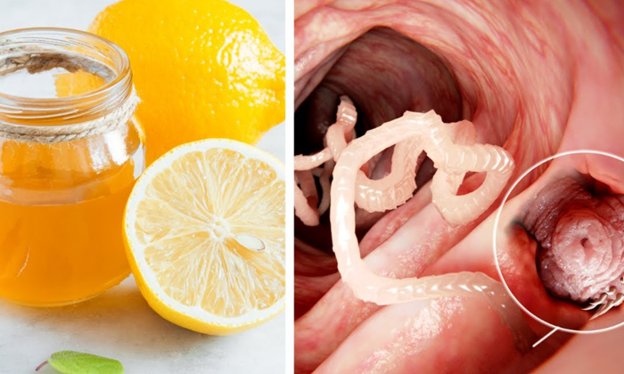  Best Ways To Cure Stomach Worms!,stomach Worms, Parasitic Worms, Orange Peel, Gr-TeluguStop.com