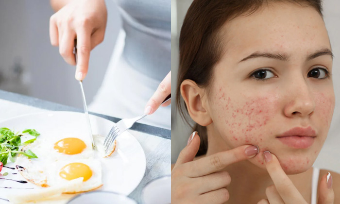 Telugu Cholestrol, Eggs, Tips, Pimples, Telugu-Telugu Health