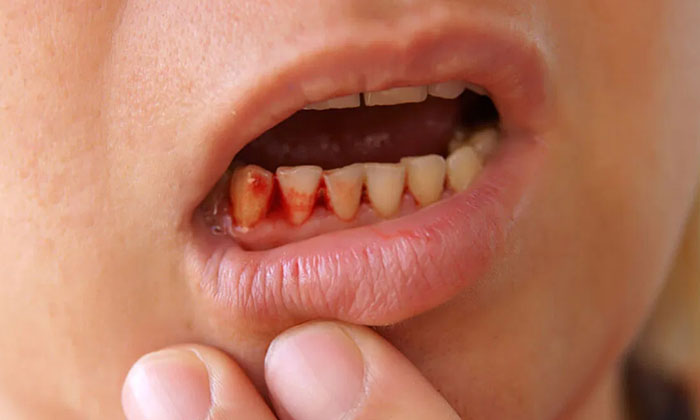 Telugu Bacteria, Soda, Coconut Oil, Care, Gums Teeth, Problems, Lauric Acid, Oil Telugu Bacteria, Soda, Coconut Oil, Care, Gums Teeth, Problems, Lauric Acid, Oil