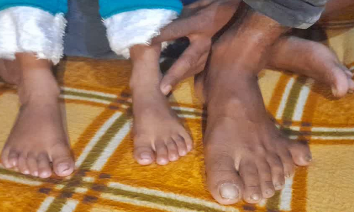  150 Members Of A Panipat Family Have Extra Fingers Toes Details, Polydactyly, Ex-TeluguStop.com