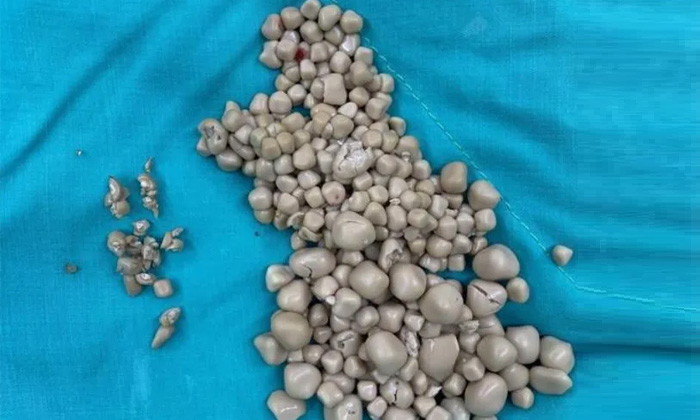  Taiwan Doctors Remove 300 Kidney Stones From Woman Who Drank Bubble Tea Instead-TeluguStop.com