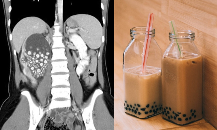 Telugu Bubble Tea, Chronic, Kidney, Nephrolithotomy, Surgery, Beverages, Taiwan,