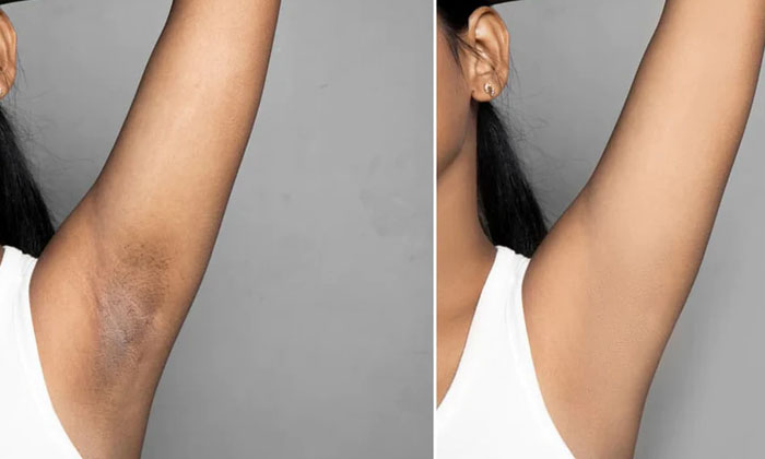  Say Goodbye To Dark Underarms With This Home Remedy! Dark Underarms, Home Remedy-TeluguStop.com