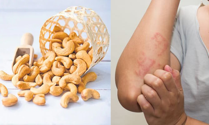  Eating Too Much Cashew Nuts Is Dangerous To Health Details, Cashew, Cashew Nuts,-TeluguStop.com