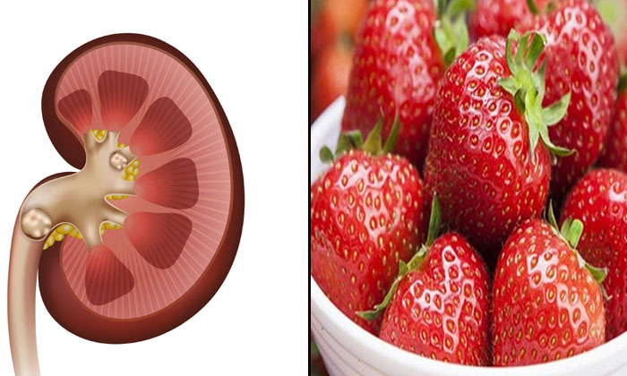  These Super Foods Help To Reduce Kidney Stones Risk! Kidney Stones, Super Foods,-TeluguStop.com