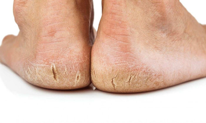  Apply This Cream Every Night To Get Rid Of Cracked Feet Forever-TeluguStop.com