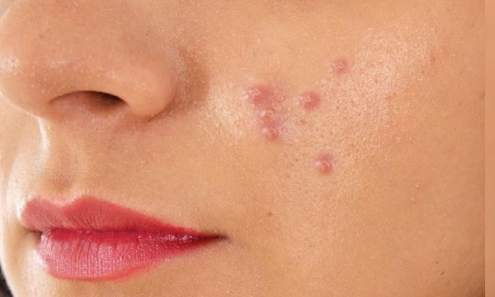 Telugu Acne, Acne Skin, Tips, Clear Skin, Remedy, Latest, Pimples, Skin Care, Sk