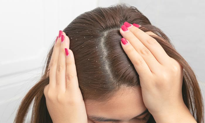  How To Get Rid Of Dandruff With Orange Peel! Dandruff, Orange Peel, Orange Peel-TeluguStop.com