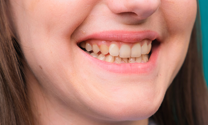  Say Bye Bye To Yellow Teeth With This Home Remedy Details, Home Remedy, Yellow-TeluguStop.com