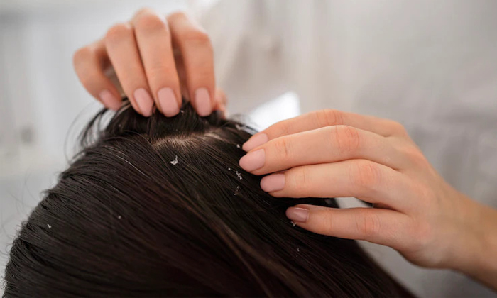  Try This Natural Hair Toner To Get Rid Of Lice Details, Natural Hair Toner, Hair-TeluguStop.com