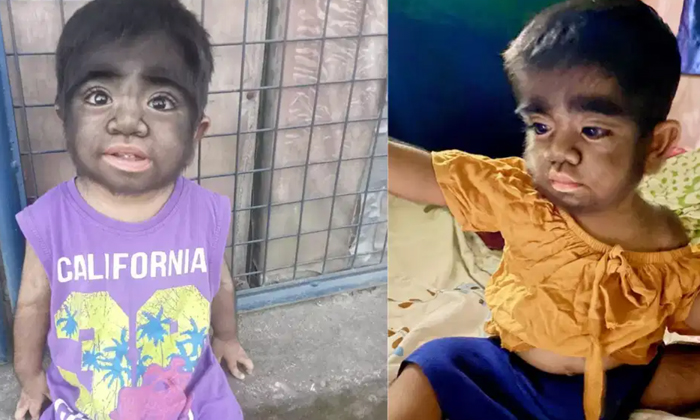 Telugu Hypertrichosis, Latest, Mothereats, Pregency-Latest News - Telugu