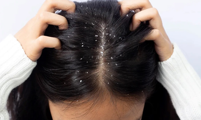  Follow This Simple Remedy Before Washing Your Hair To Get Rid Of Dandruff! Simpl-TeluguStop.com