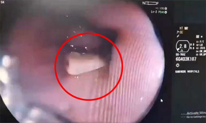  Kamineni Doctors Successfully Removed Mutton Bone In Throat Details, Viral Video-TeluguStop.com