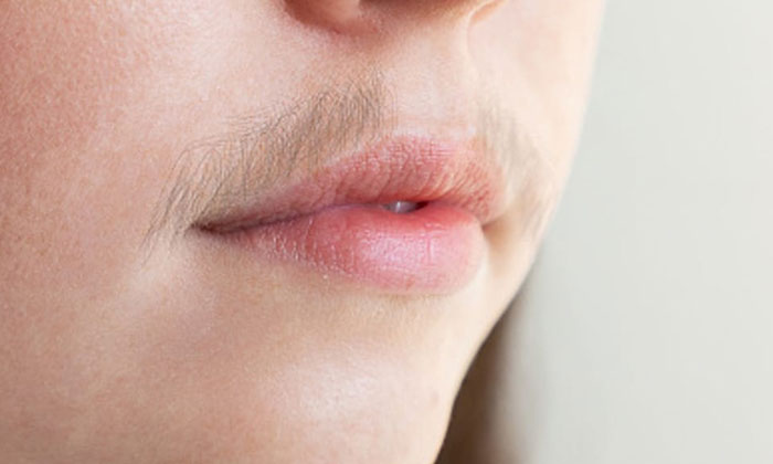  This Home Remedy Helps To Remove Hair For Your Upper Lip! Home Remedy, Upper Lip-TeluguStop.com