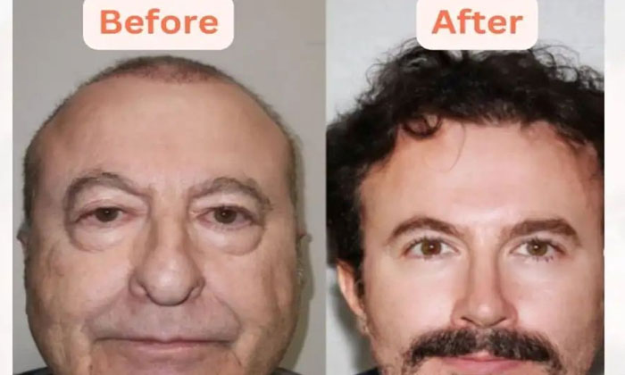  Turkish People Are Becoming 30 Years Younger With Surgery, Facial Makeovers, Cos-TeluguStop.com