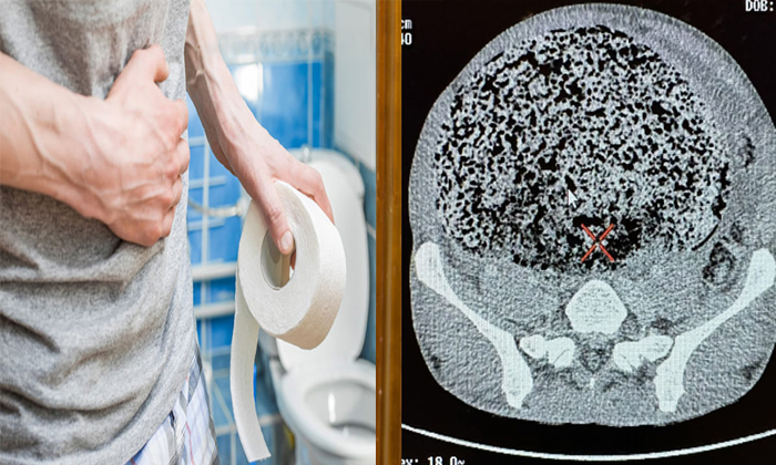  Horrifying Scans Reveal What Happened When Man Struggled To Go For A Poo For Thr-TeluguStop.com
