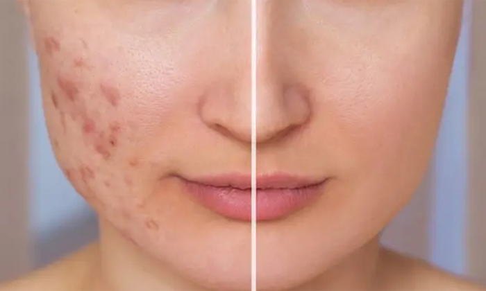  Follow This Home Remedy To Get Rid Of Acne And Acne Marks Details, Acne, Acne M-TeluguStop.com