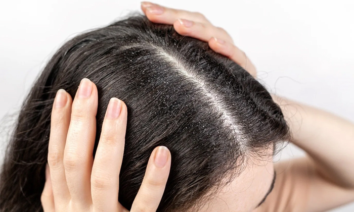  Try This Effective Remedy To Get Rid Of Dandruff Details, Effective Remedy, Dan-TeluguStop.com