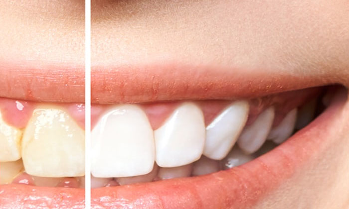 Telugu Tips, Healthy Teeth, Latest, Oral, Teeth, White Teeth-Telugu Health