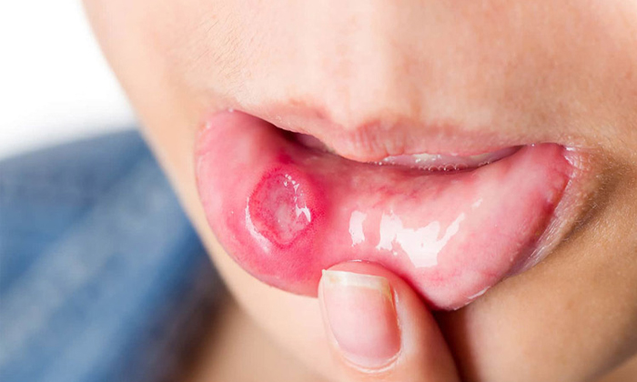  Follow These Home Remedies To Get Rid Of Mouth Ulcers Details, Home Remedies, Mo-TeluguStop.com