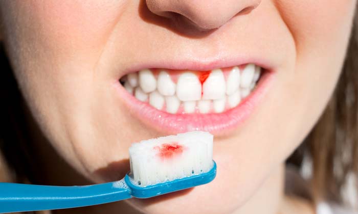  Following These Tips Will Stop Bleeding Gums! Bleeding Gums, Simple Tips, Stop B-TeluguStop.com