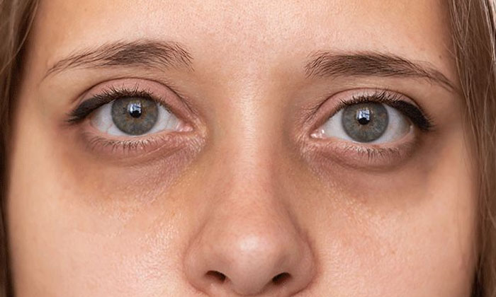  Say Goodbye To Dark Circles Around The Eyes With These Simple Tips , Simple Ti-TeluguStop.com