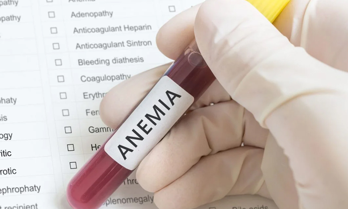  Anemia Diagnosis Tests From 14 Of This Month, Anemia Diagnosis Tests , Anemia Te-TeluguStop.com