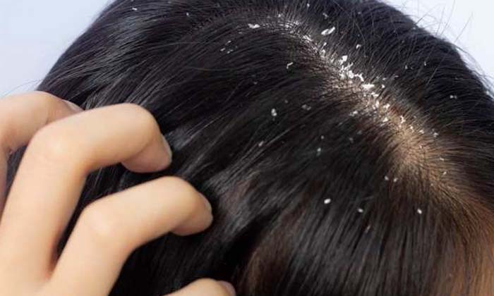  Say Goodbye To Dandruff With This Powerful Remedy! Powerful Remedy, Dandruff, Da-TeluguStop.com