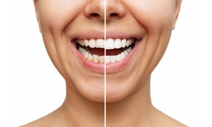  This Is A Simple And Effective Remedy To Whiten Yellow Teeth Details, Yellow Te-TeluguStop.com