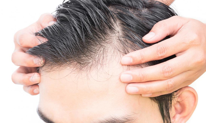  This Is The Best Solution For Men Suffering From Excessive Hair Fall Details, H-TeluguStop.com