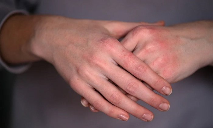  Follow These Tips To Avoid Dry Hands In Winter Details, Winter, Dry Skin, Dry Ha-TeluguStop.com