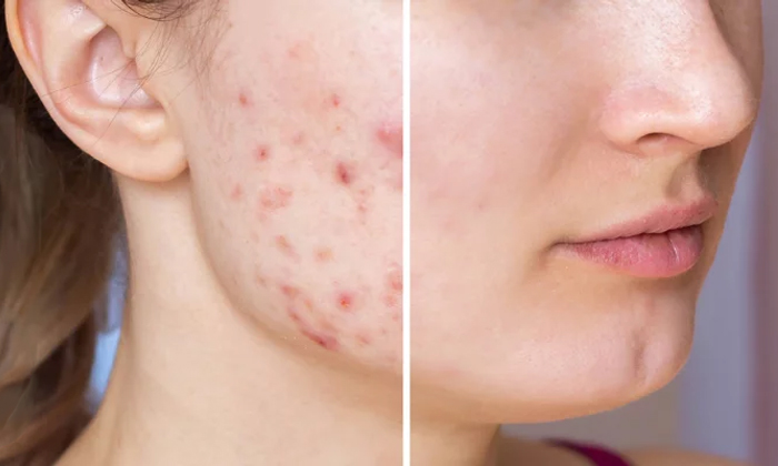  This Home Remedy Helps To Get Rid Of Acne Details, Acne, Acne Free Skin, Skin C-TeluguStop.com