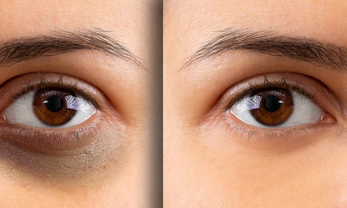  Follow These Simple Tips To Get Rid Of Dark Circles! Dark Circles, Simple Tips,-TeluguStop.com