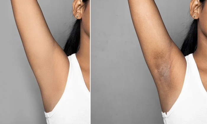  This Home Remedy Removes Darkness In Underarms Details, Underarms, Dark Underar-TeluguStop.com