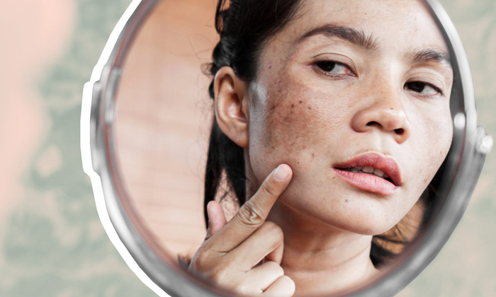 These Are Effective Remedies To Get Rid Of Dark Spots On Face! Home Remedies, Da These Are Effective Remedies To Get Rid Of Dark Spots On Face! Home Remedies, Da-TeluguStop.com