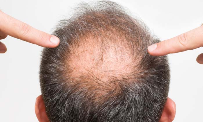 Telugu Bald Scalp, Care, Care Tips, Healthy, Homemade Tonic, Tonicpromotes-Telug Telugu Bald Scalp, Care, Care Tips, Healthy, Homemade Tonic, Tonicpromotes-Telug