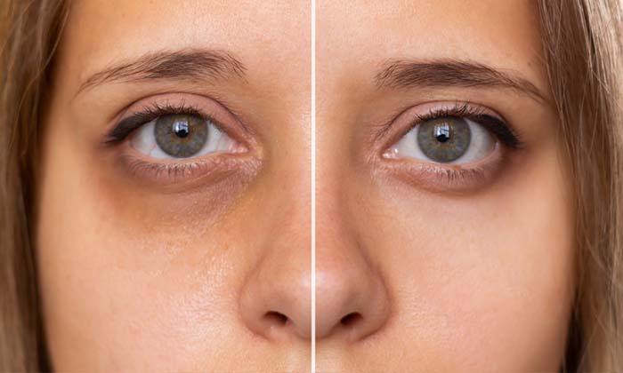  These Are Effective Remedies That Will Get Rid Of Dark Circles In Just A Week! E-TeluguStop.com